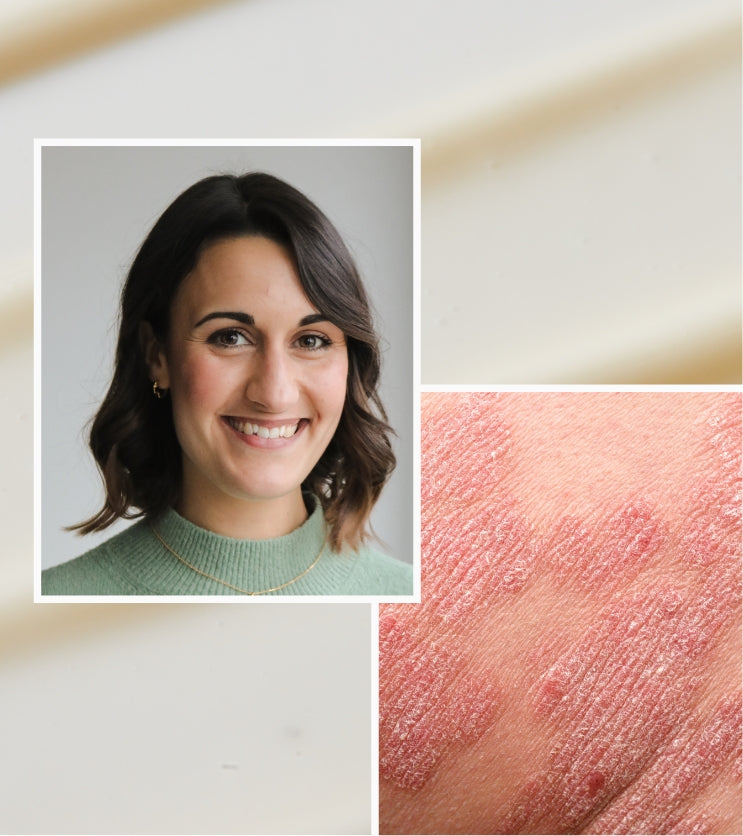 Soothing psoriasis