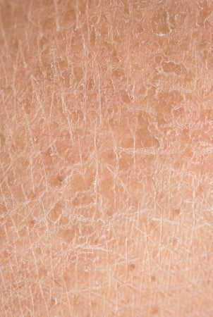 closeup of dry skin