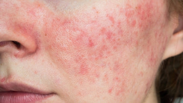 what is rosacea